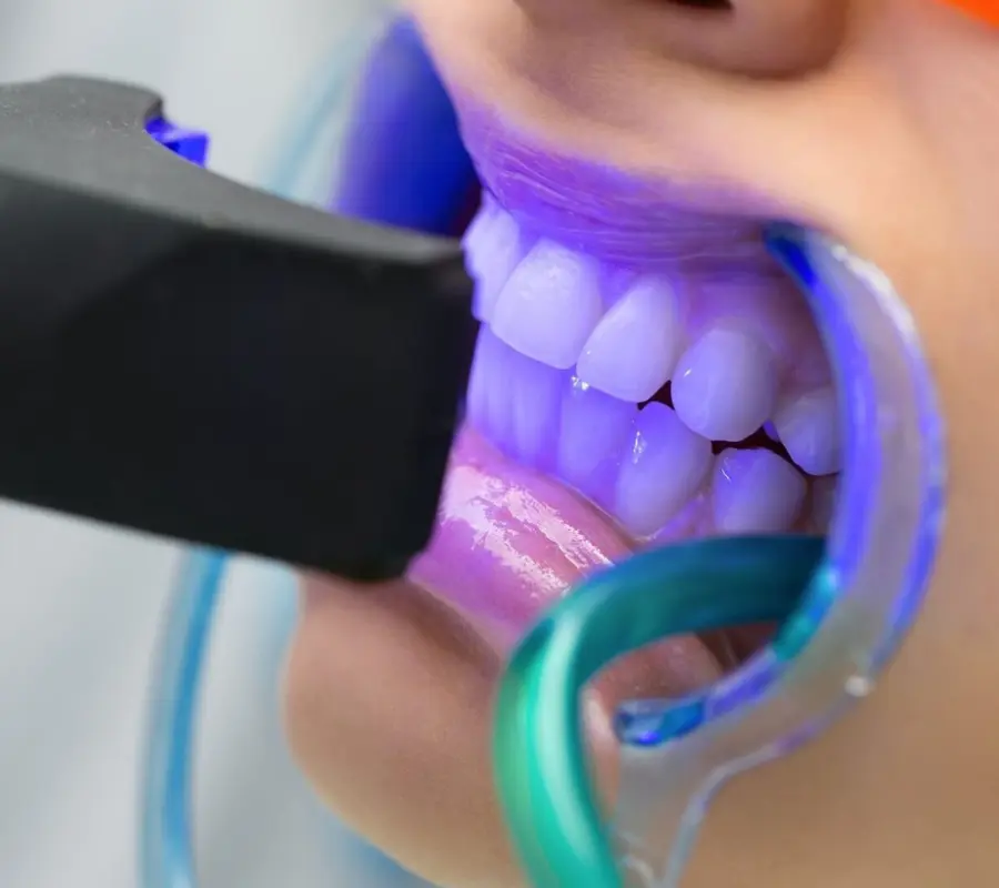 Blanqueamiento Dental