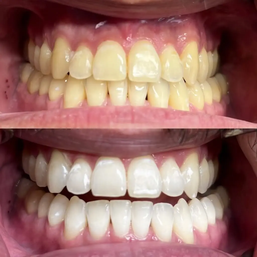 Resultado carillas de porcelana