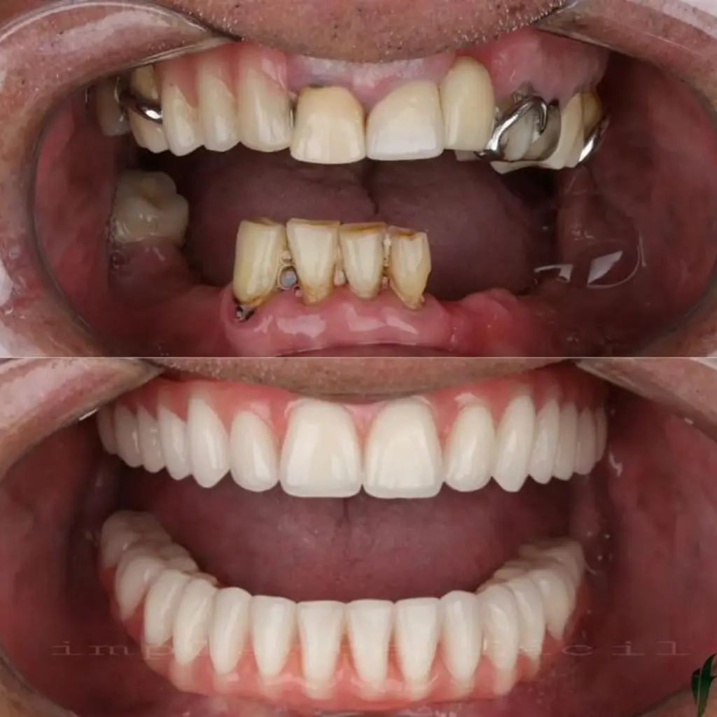 Resultado implantes dentales