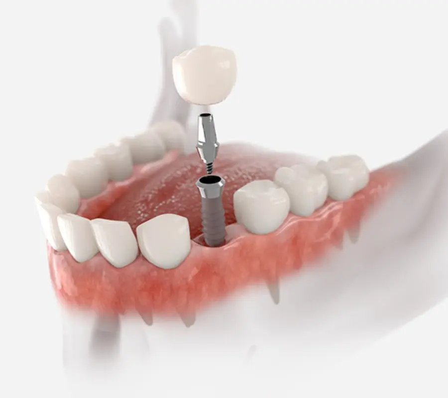 Implantes Dentales